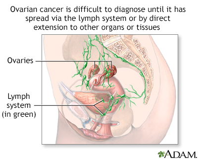 Ovarian cancer white blood cell count